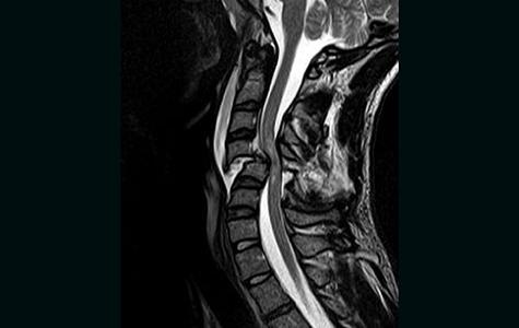 Cervical Spine MRI of patient with SCI. Credit: Андрей Королев 86 (CC BY-SA 3.0)